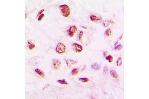 Immunohistochemical analysis of Histone Deacetylase 9 staining in human lung cancer formalin fixed paraffin embedded tissue section. (HDAC9 Antikörper  (C-Term))