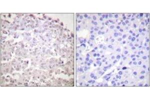 Immunohistochemistry analysis of paraffin-embedded human breast carcinoma tissue, using GADD153 Antibody. (DDIT3 Antikörper  (AA 91-140))