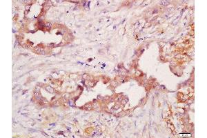 Formalin-fixed and paraffin embedded human lung carcinoma labeled with Anti-Polyclonal Antibody, Unconjugated 1:200 followed by conjugation to the secondary antibody and DAB staining