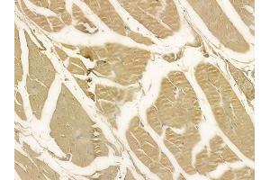 ABIN6256857 and ABIN6273593 at 1/100 staining human tongue carcinoma by IHC-P. (TRIM31 Antikörper  (Internal Region))