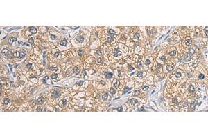 Immunohistochemistry of paraffin-embedded Human liver cancer tissue using GAB4 Polyclonal Antibody at dilution of 1:60(x200) (GAB4 Antikörper)