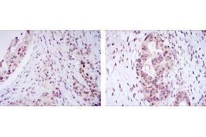 Immunohistochemical analysis of paraffin-embedded mammary cancer tissues (left) and ovarian cancer tissues (right) using NACC1 mouse mAb with DAB staining. (NAC1 Antikörper)