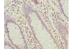 Immunohistochemistry of paraffin-embedded human colon cancer using ABIN7155961 at dilution of 1:100 (HABP2 Antikörper  (AA 314-560))