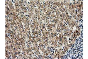 Immunohistochemical staining of paraffin-embedded Human liver tissue using anti-SOCS3 mouse monoclonal antibody.