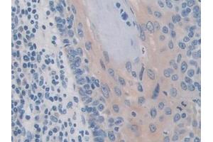 Detection of IREB2 in Human Skin cancer Tissue using Polyclonal Antibody to Iron Responsive Element Binding Protein 2 (IREB2) (IREB2 Antikörper  (AA 39-281))