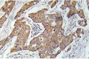 Immunohistochemistry (IHC) analyzes of VEGFR2 pAb in paraffin-embedded human prostate carcinoma tissue. (VEGFR2/CD309 Antikörper)