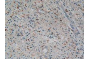 IHC-P analysis of Human Prostate Gland Cancer Tissue, with DAB staining. (Gelsolin Antikörper  (AA 577-771))
