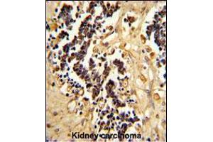 Formalin-fixed and paraffin-embedded human kidney carcinoma reacted with EHD3 Antibody , which was peroxidase-conjugated to the secondary antibody, followed by DAB staining. (EHD3 Antikörper  (AA 189-216))