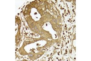 Immunohistochemistry of paraffin-embedded human liver cancer using ACTR2 antibody. (ACTR2 Antikörper  (AA 1-160))