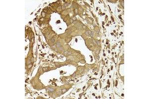 Immunohistochemistry of paraffin-embedded human liver cancer using ACTR2 antibody.