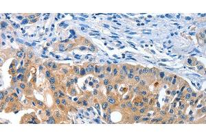 Immunohistochemistry of paraffin-embedded Human lung cancer tissue using AMHR2 Polyclonal Antibody at dilution 1:40 (AMHR2 Antikörper)