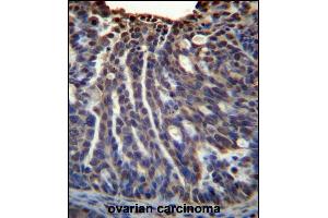 HOXB3 Antibody (Center) (ABIN656507 and ABIN2845779) immunohistochemistry analysis in formalin fixed and paraffin embedded human ovarian carcinoma followed by peroxidase conjugation of the secondary antibody and DAB staining. (HOXB3 Antikörper  (AA 119-148))