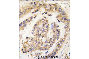 Formalin-fixed and paraffin-embedded human lung carcinoma tissue reacted with OLFM1 polyclonal antibody  , which was peroxidase-conjugated to the secondary antibody, followed by DAB staining. (Olfactomedin 1 Antikörper  (N-Term))