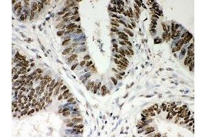 IHC-P: Nucleophosmin antibody testing of human intestine cancer tissue (NPM1 Antikörper  (AA 1-294))