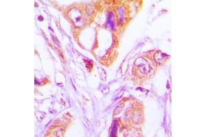 Immunohistochemical analysis of FADD staining in human lung cancer formalin fixed paraffin embedded tissue section. (FADD Antikörper  (Center))