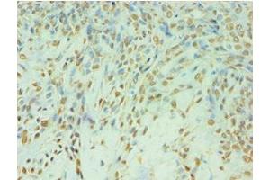 Immunohistochemistry of paraffin-embedded human breast cancer using ABIN7174129 at dilution of 1:100 (TDP1 Antikörper  (AA 1-260))