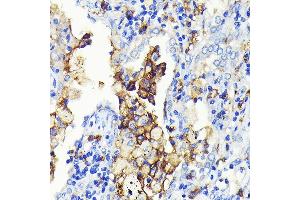 Immunohistochemistry of paraffin-embedded human lung cancer using CD14 Rabbit mAb (ABIN7266167) at dilution of 1:100 (40x lens). (CD14 Antikörper)