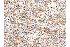 The image on the left is immunohistochemistry of paraffin-embedded Human prostate cancer tissue using ABIN7192435(SLC24A3 Antibody) at dilution 1/20, on the right is treated with synthetic peptide. (SLC24A3 Antikörper)