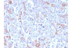 Formalin-fixed, paraffin-embedded human Pancreatic Carcinoma stained with MRP3 Mouse Monoclonal Antibody (ABCC3/2971).