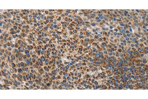 Immunohistochemistry of paraffin-embedded Human liver cancer using UPF1 Polyclonal Antibody at dilution of 1:35 (RENT1/UPF1 Antikörper)