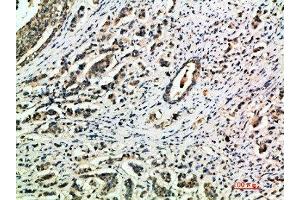 Immunohistochemical analysis of paraffin-embedded human-breast-cancer, antibody was diluted at 1:200 (Integrin alpha 1 Antikörper  (AA 920-980))
