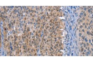 Immunohistochemistry of paraffin-embedded Human cervical cancer tissue using UCK1 Polyclonal Antibody at dilution 1:50 (UCK1 Antikörper)