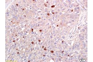Formalin-fixed and paraffin embedded human lung carcinoma labeled with Anti-ATF2 Polyclonal Antibody, Unconjugated (ABIN669546) at 1:200 followed by conjugation to the secondary antibody and DAB staining. (ATF2 Antikörper  (AA 188-255))
