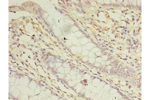 Immunohistochemistry of paraffin-embedded human colon cancer using ABIN7144199 at dilution of 1:100 (ASB8 Antikörper  (AA 12-288))