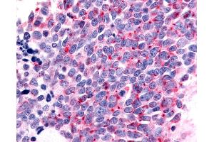 Anti-OR6K3 antibody IHC of human Lung, Small Cell Carcinoma. (OR6K3 Antikörper  (C-Term))