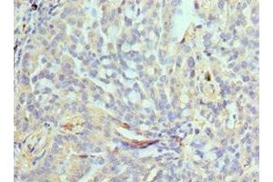 Immunohistochemistry of paraffin-embedded human lung cancer using ABIN7161635 at dilution of 1:100 (NPRL2 Antikörper  (AA 1-220))