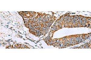 Immunohistochemistry of paraffin-embedded Human colorectal cancer tissue using PRELID3B Polyclonal Antibody at dilution of 1:90(x200) (SLMO2 Antikörper)