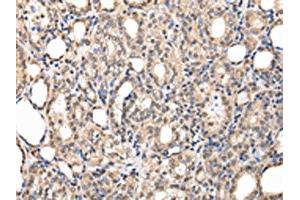 The image on the left is immunohistochemistry of paraffin-embedded Human thyroid cancer tissue using ABIN7127989(PPIL1 Antibody) at dilution 1/30, on the right is treated with fusion protein. (PPIL1 Antikörper)