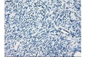Immunohistochemical staining of paraffin-embedded Adenocarcinoma of breast tissue using anti-PDE10A mouse monoclonal antibody. (PDE10A Antikörper)