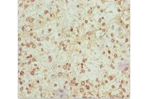 Immunohistochemistry of paraffin-embedded human glioma using ABIN7160986 at dilution of 1:100 (NDUFS1 Antikörper  (AA 80-290))