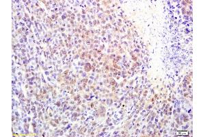 Formalin-fixed and paraffin embedded mouse lymphoma labeled with Rabbit Anti alpha MSH Polyclonal Antibody, Unconjugated (ABIN735323) at 1:200 followed by conjugation to the secondary antibody and DAB staining (MSH alpha (AA 138-150) Antikörper)