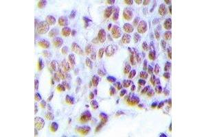 Immunohistochemical analysis of MGMT staining in human prostate cancer formalin fixed paraffin embedded tissue section. (MGMT Antikörper  (N-Term))
