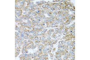 Immunohistochemistry of paraffin-embedded human liver cancer using NDUFA2 antibody. (NDUFA2 Antikörper)