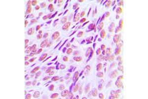 Immunohistochemical analysis of RUNX1 staining in human breast cancer formalin fixed paraffin embedded tissue section. (RUNX1 Antikörper  (Center))
