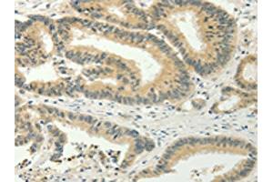 The image on the left is immunohistochemistry of paraffin-embedded Human colon cancer tissue using ABIN7128020(SPIN4 Antibody) at dilution 1/20, on the right is treated with fusion protein. (SPIN4 Antikörper)