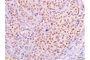 Formalin-fixed and paraffin embedded transplanted tumor of cervical carcinoma in nude mice labeled with Anti-MTA1 Polyclonal Antibody, Unconjugated (ABIN686182) at 1:300, followed by conjugation to the secondary antibody and DAB staining (MTA1 Antikörper  (AA 601-715))