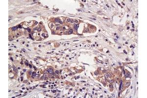 Formalin-fixed and paraffin embedded human endometrial carcinoma labeled with Anti- Hpt/Haptoglobin Polyclonal Antibody, Unconjugated (ABIN734738) at 1:200 followed by conjugation to the secondary antibody and DAB staining (Haptoglobin Antikörper  (AA 251-350))