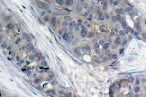 Immunohistochemistry (IHC) analyzes of p-IRS-1 antibody in paraffin-embedded human breast carcinoma tissue. (IRS1 Antikörper  (pSer307))