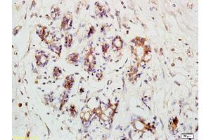 Formalin-fixed and paraffin embedded human breast carcinoma labeled with Anti- RPS3 Polyclonal Antibody, Unconjugated (ABIN872550) at 1:200 followed by conjugation to the secondary antibody (RPS3 Antikörper  (AA 101-200))