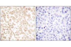 Immunohistochemistry analysis of paraffin-embedded human breast carcinoma tissue, using Fra-2 Antibody. (FOSL2 Antikörper  (AA 271-320))