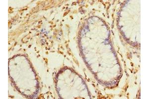 Immunohistochemistry of paraffin-embedded human colon cancer using ABIN7145650 at dilution of 1:100 (BRINP2 Antikörper  (AA 34-300))