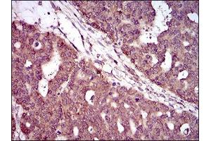 Immunohistochemical analysis of paraffin-embedded ovarian cancer tissues using PIWIL4 mouse mAb with DAB staining. (PIWIL4 Antikörper  (AA 304-434))