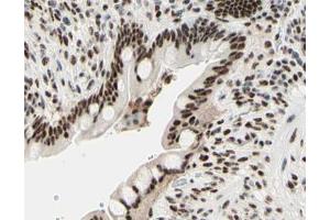 ABIN6267567 at 1/200 staining human colon cancer tissue sections by IHC-P. (Histone H3.1 Antikörper  (pSer10))