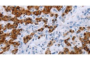 Immunohistochemistry of paraffin-embedded Human liver cancer tissue using NDUFA12 Polyclonal Antibody at dilution 1:50 (NDUFA12 Antikörper)