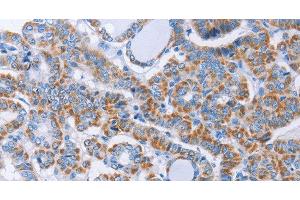 Immunohistochemistry of paraffin-embedded Human thyroid cancer using KIF3A Polyclonal Antibody at dilution of 1:40 (KIF3A Antikörper)