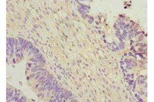 Immunohistochemistry of paraffin-embedded human ovarian cancer using ABIN7166313 at dilution of 1:100 (WNT7B Antikörper  (AA 120-349))